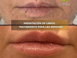 Hidratación de labios + tratamiento para las arrugas del tercio superior