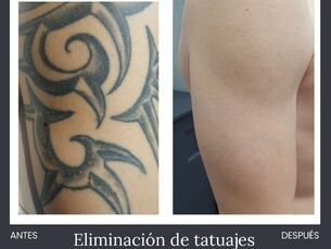 Eliminación de tatuajes
