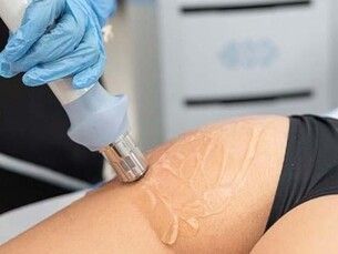 Ondas de choque para grasa rebelde