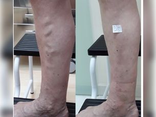 Nº 1👉Elimina Varices SIN Cirugía