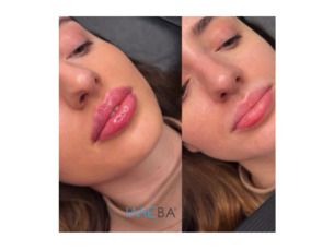 Aumento de Labios - natural - volumen - perfilado - hidratación