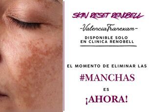 DI ADIÓS A MANCHAS DE SOL , MELASMAS , HIPERPIMENTACIONES HORMONALES...