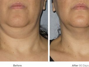 Ultherapy lifting facial-cuello