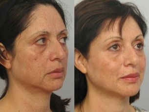 Lifting sin cirugía - Ultherapy-