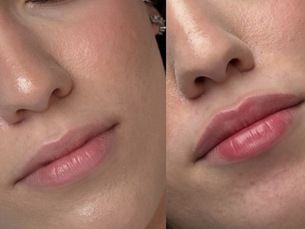 Aumento de Labios naturales...con Clinicas IMEBA®