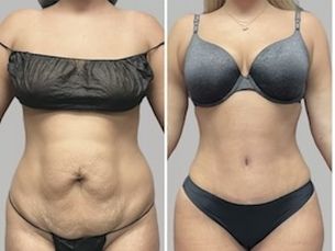 RENACE TU FIGURA :Corrección de abdomen + pecho