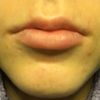 Aumento de labios (La Línea de la Concepción) - 2112