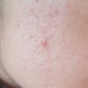 Que solucion hay para los agujeros de acné ?