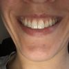 Sonrisa gingival hipermovilidad labio superior - 2847