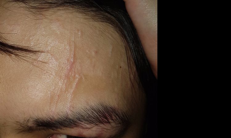 Quitar cicatriz frente - 3223