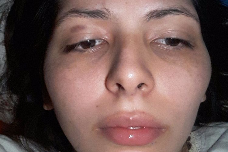 Es posible limar el hueso del pomulo ??