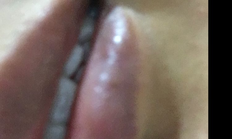 Ayuda: problemas con aumento de labios - 3974