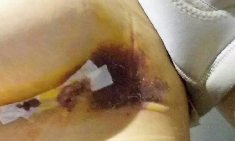 Hematoma mamoplastia aumento - 4132