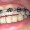 ¿Como tapar manchas blancas de los dientes? - 4293