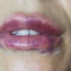 Bultos duros tras aumento de labios con filler princess - 4852