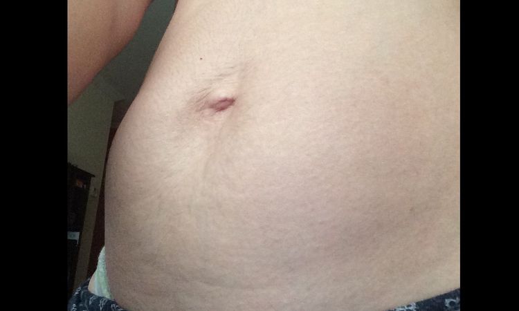 Hernia umbilical y diastasis abdominal - 5198