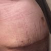 Disgustada por la abdominoplastia