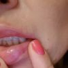 ¿Se pueden quitar granulomas de los labios? - 5704