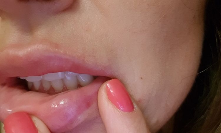 ¿Se pueden quitar granulomas de los labios? - 5704