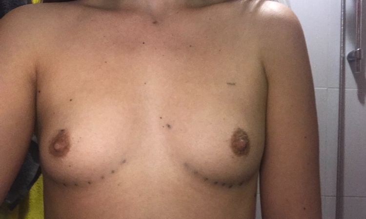 Me conviene subfascial anatómicas 280cc? - 5853