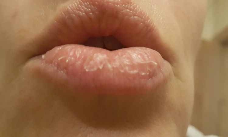 Queilitis exfoliativa en labio inferior y despigmentación por quemadura con estr - 6322