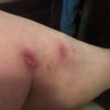 heridas de escleroterapia mal curadas