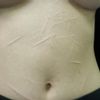 Quiero quitar estás cicatrices en el abdomen
