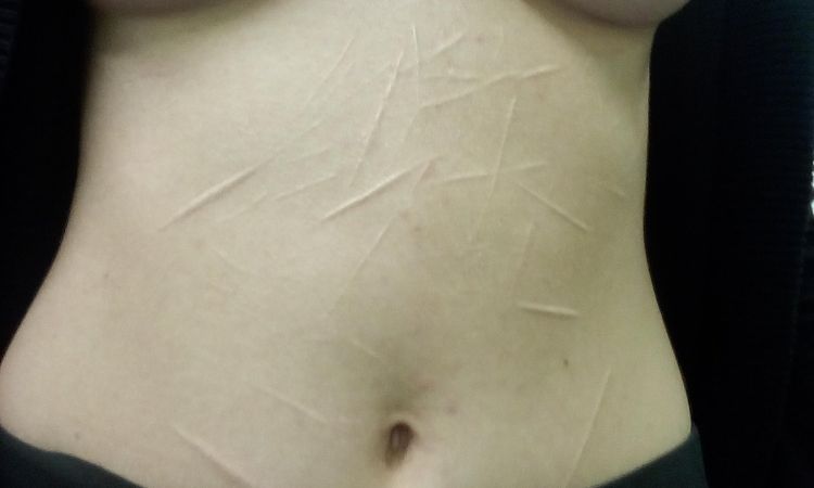 Quiero quitar estás cicatrices en el abdomen - 6403