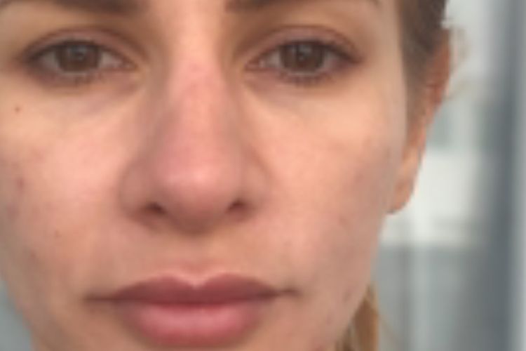 Rinoplastia punta nasal dura