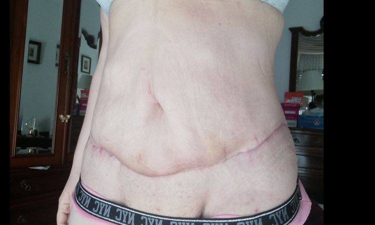 Evitar abdominoplastia en ancla - 6519