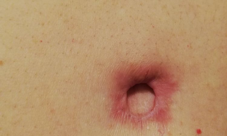 Cicatriz ombligo después abdominoplastia - 6631