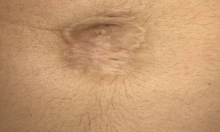 Ombligo deformado tras operación de hernia umbilical y umbilicoplastia - 6649