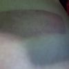 Cuantos tipos de máquinas de Coolsculpting hay?