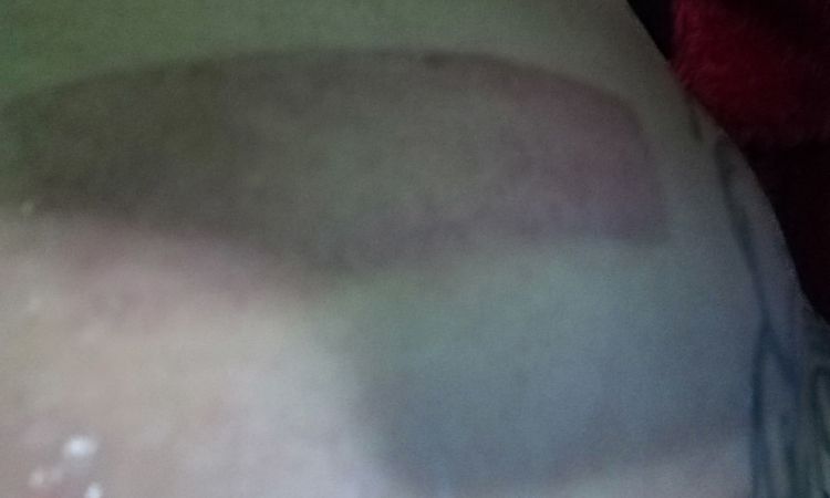 Cuantos tipos de máquinas de Coolsculpting hay? - 6683