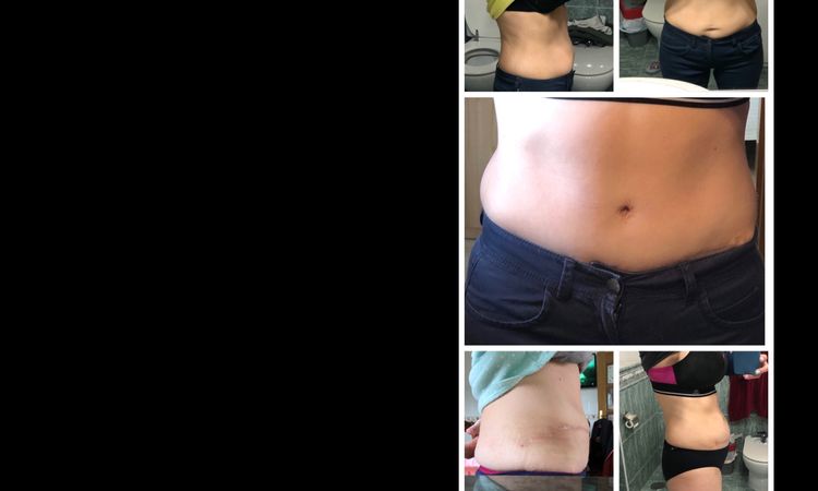 Abdomen más abultado después de una abdominoplastia - 6692