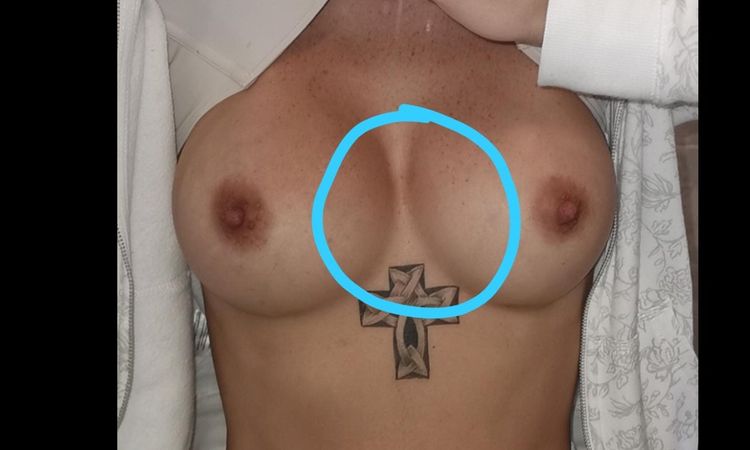Dolor en los bordes del canalillo?? - 6730