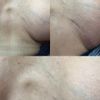 Cicatriz Mastopexia está bien hecha ?