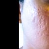 Hilos tensores para cicatrices de acne - 6861