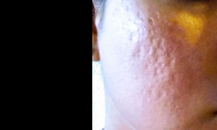 Hilos tensores para cicatrices de acne - 6861