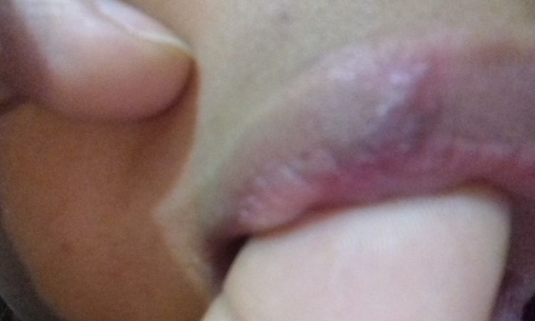 Bulto duro en cicatriz después de sacar puntos, ¿Es normal o qué hago? - 6864