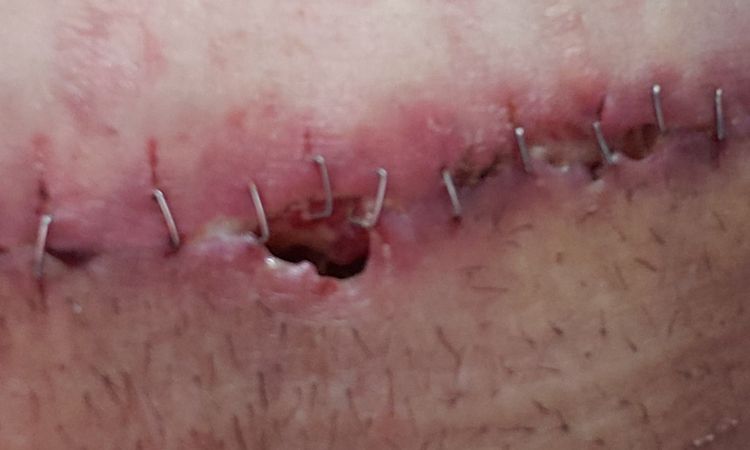 Porque se hacen hoyos en la cicatriz de una lipectomia - 7108