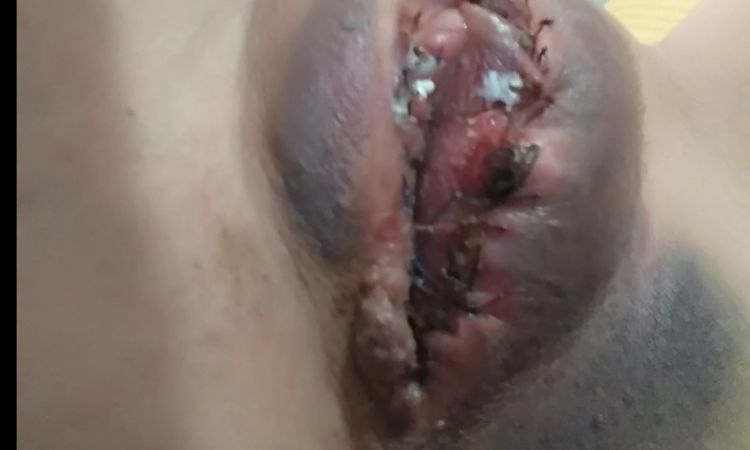 Labioplastia Hematoma - 7205