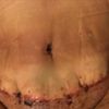 Mi costura de abdominoplastia quedó fea con pliegues