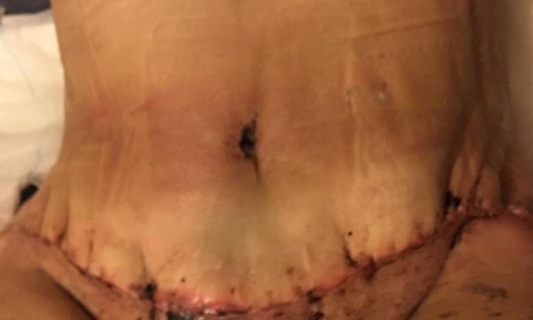 Mi costura de abdominoplastia quedó fea con pliegues - 7239