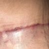 Queloide en abdominoplastia