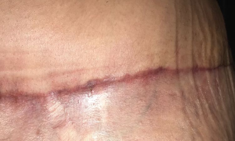 Queloide en abdominoplastia - 7425