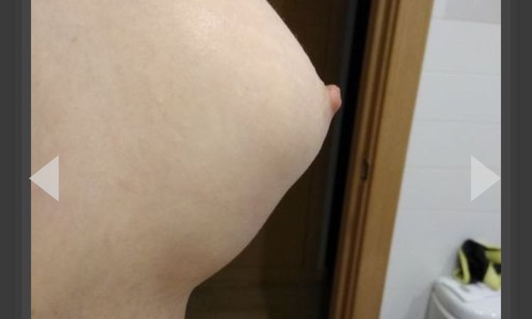 Inflamación o doble surco? - 7573
