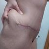 Grasa despues de abdominoplastia.