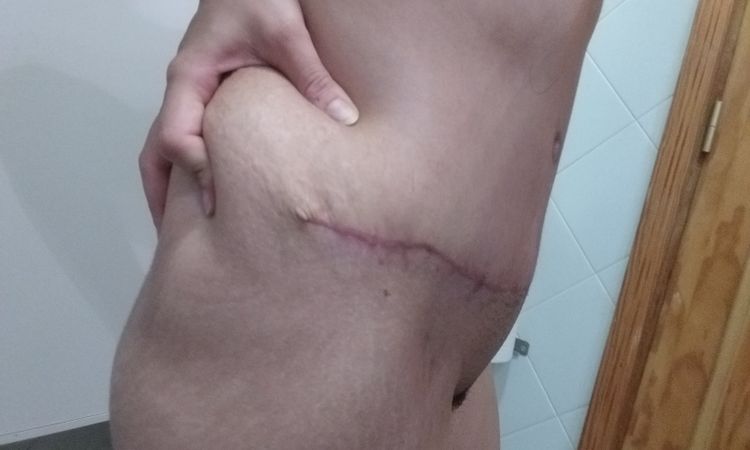 Grasa despues de abdominoplastia. - 7575