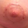 Evolución cicatriz areola